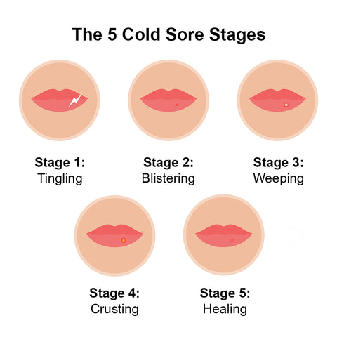 5 Cold Sore Stages