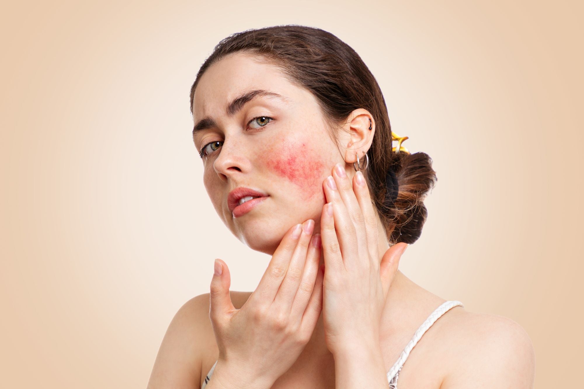 A woman holds her face, wondering how to get rid of redness from acne on one cheek.