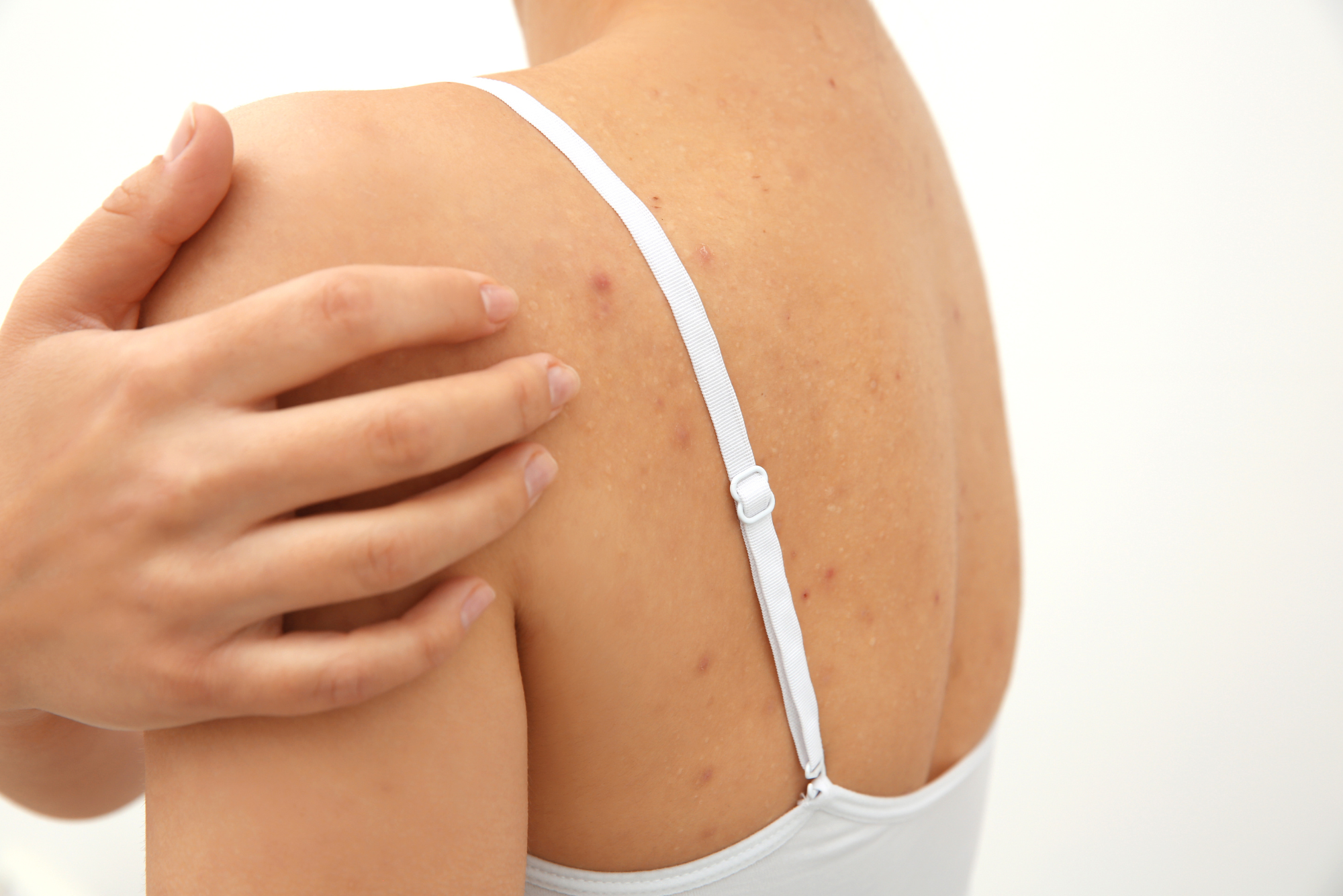 A woman’s hand covers a breakout on her shoulder while she wonders how to get rid of shoulder acne.