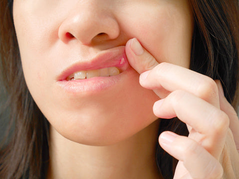 A woman pulls back her upper lip to reveal a canker sore.