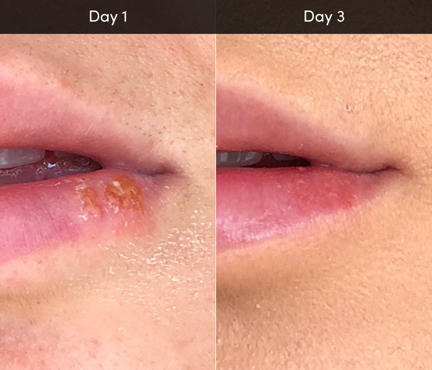 Lip Sore Treatment Device - Pro - Luminance RED